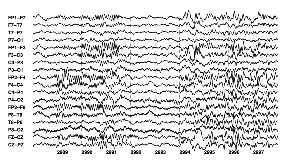 23-channel bipolar-montage scalp EEG showing rhythmic, high-amplitude ictal discharge across channels FP1–F7 through CZ–PZ over roughly a ten-second window